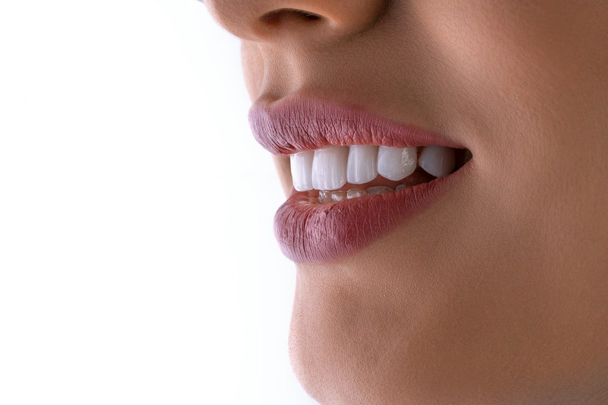 Close de sorriso com dentes claros após clareamento dental