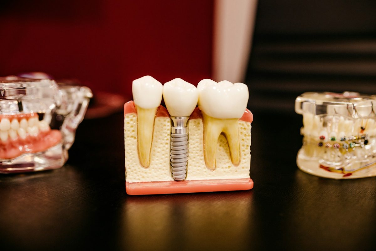 Modelo em corte mostrando o pino de titânio do implante dentário fixado no osso, com a coroa por cima