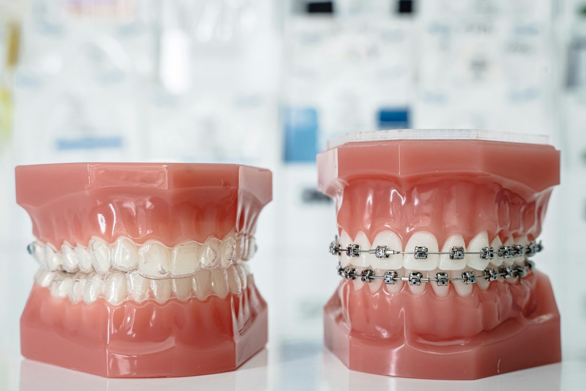 Modelos odontológicos com aparelho estético transparente e aparelho metálico lado a lado