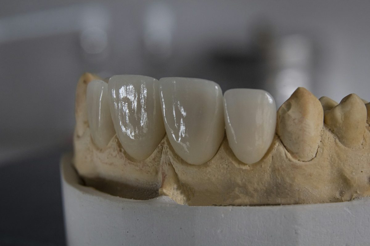 Coroas de cerâmica em modelo de arcada, prontas para instalação sobre implantes